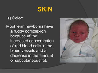 SKIN
a) Color:
Most term newborns have
a ruddy complexion
because of the
increased concentration
of red blood cells in the
blood vessels and a
decrease in the amount
of subcutaneous fat.
 