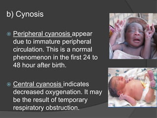 b) Cynosis
 Peripheral cyanosis appear
due to immature peripheral
circulation. This is a normal
phenomenon in the first 24 to
48 hour after birth.
 Central cyanosis indicates
decreased oxygenation. It may
be the result of temporary
respiratory obstruction.
 