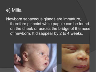 e) Milia
Newborn sebaceous glands are immature,
therefore pinpoint white papule can be found
on the cheek or across the bridge of the nose
of newborn. It disappear by 2 to 4 weeks.
 