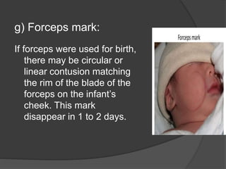 g) Forceps mark:
If forceps were used for birth,
there may be circular or
linear contusion matching
the rim of the blade of the
forceps on the infant’s
cheek. This mark
disappear in 1 to 2 days.
 