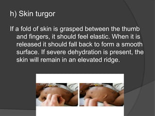 h) Skin turgor
If a fold of skin is grasped between the thumb
and fingers, it should feel elastic. When it is
released it should fall back to form a smooth
surface. If severe dehydration is present, the
skin will remain in an elevated ridge.
 