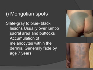 i) Mongolian spots
Slate-gray to blue- black
lesions Usually over lumbo
sacral area and buttocks
Accumulation of
melanocytes within the
dermis. Generally fade by
age 7 years
 