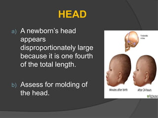 HEAD
a) A newborn’s head
appears
disproportionately large
because it is one fourth
of the total length.
b) Assess for molding of
the head.
 