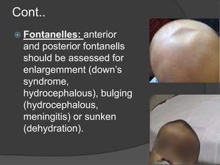 Cont..
 Fontanelles: anterior
and posterior fontanells
should be assessed for
enlargemment (down’s
syndrome,
hydrocephalous), bulging
(hydrocephalous,
meningitis) or sunken
(dehydration).
 