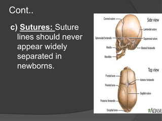 Cont..
c) Sutures: Suture
lines should never
appear widely
separated in
newborns.
 