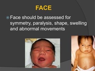 FACE
 Face should be assessed for
symmetry, paralysis, shape, swelling
and abnormal movements
 