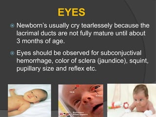 EYES
 Newborn’s usually cry tearlessely because the
lacrimal ducts are not fully mature until about
3 months of age.
 Eyes should be observed for subconjuctival
hemorrhage, color of sclera (jaundice), squint,
pupillary size and reflex etc.
 