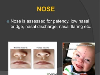 NOSE
 Nose is assessed for patency, low nasal
bridge, nasal discharge, nasal flaring etc.
 