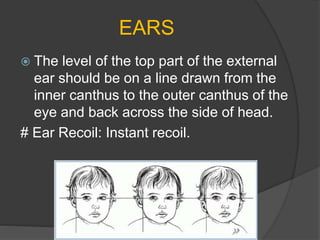 EARS
 The level of the top part of the external
ear should be on a line drawn from the
inner canthus to the outer canthus of the
eye and back across the side of head.
# Ear Recoil: Instant recoil.
 