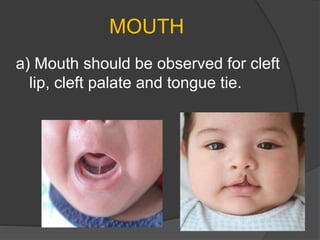 MOUTH
a) Mouth should be observed for cleft
lip, cleft palate and tongue tie.
 