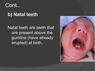 Cont..
b) Natal teeth
Natal teeth are teeth that
are present above the
gumline (have already
erupted) at birth,
 
