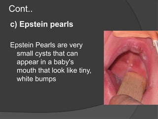 Cont..
c) Epstein pearls
Epstein Pearls are very
small cysts that can
appear in a baby's
mouth that look like tiny,
white bumps
 