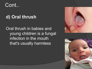 Cont..
d) Oral thrush
Oral thrush in babies and
young children is a fungal
infection in the mouth
that's usually harmless
 