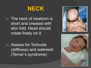 NECK
a) The neck of newborn is
short and creased with
skin fold. Head should
rotate freely on it.
b) Assess for Torticolis
(stiffness) and webneck
(Terner’s syndrome)
 