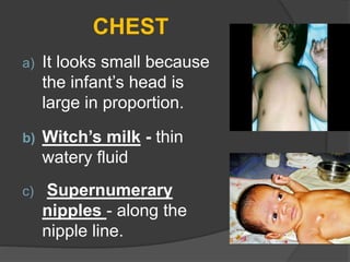 CHEST
a) It looks small because
the infant’s head is
large in proportion.
b) Witch’s milk - thin
watery fluid
c) Supernumerary
nipples - along the
nipple line.
 