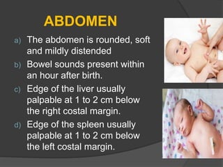 ABDOMEN
a) The abdomen is rounded, soft
and mildly distended
b) Bowel sounds present within
an hour after birth.
c) Edge of the liver usually
palpable at 1 to 2 cm below
the right costal margin.
d) Edge of the spleen usually
palpable at 1 to 2 cm below
the left costal margin.
 