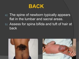 BACK
a) The spine of newborn typically appears
flat in the lumbar and sacral areas.
b) Assess for spina bifida and tuft of hair at
back
 