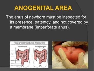 ANOGENITAL AREA
The anus of newborn must be inspected for
its presence, patentcy, and not covered by
a membrane (imperforate anus).
 