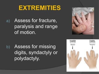 EXTREMITIES
a) Assess for fracture,
paralysis and range
of motion.
b) Assess for missing
digits, syndactyly or
polydactyly.
 