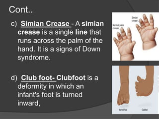 Cont..
c) Simian Crease - A simian
crease is a single line that
runs across the palm of the
hand. It is a signs of Down
syndrome.
d) Club foot- Clubfoot is a
deformity in which an
infant's foot is turned
inward,
 
