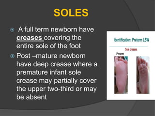 SOLES
 A full term newborn have
creases covering the
entire sole of the foot
 Post –mature newborn
have deep crease where a
premature infant sole
crease may partially cover
the upper two-third or may
be absent
 