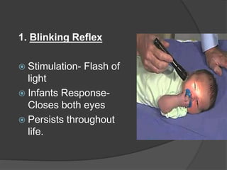 1. Blinking Reflex
 Stimulation- Flash of
light
 Infants Response-
Closes both eyes
 Persists throughout
life.
 
