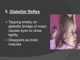 5. Glabellar Reflex
 Tapping briskly on
glabella (bridge of nose)
causes eyes to close
tightly.
 Disappers as brain
matures
 