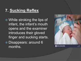 7. Sucking Reflex
 While stroking the lips of
infant, the infant’s mouth
opens and the examiner
introduces their gloved
finger and sucking starts.
 Disappears: around 6
months.
 