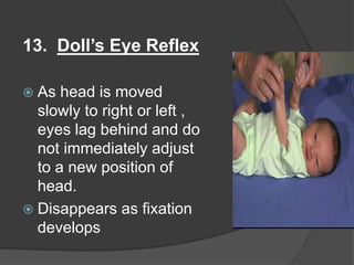 13. Doll’s Eye Reflex
 As head is moved
slowly to right or left ,
eyes lag behind and do
not immediately adjust
to a new position of
head.
 Disappears as fixation
develops
 