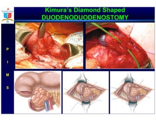 Kimura’s Diamond Shaped
DUODENODUODENOSTOMY
P
I
M
S
 