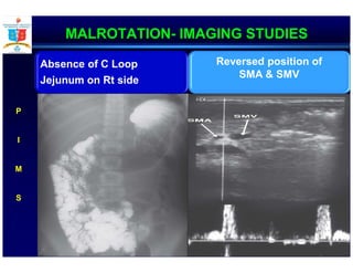 MALROTATION- IMAGING STUDIES
P
I
M
S
Absence of C Loop
Jejunum on Rt side
Reversed position of
SMA & SMV
 