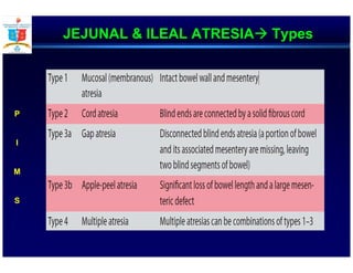 JEJUNAL & ILEAL ATRESIA Types
P
I
M
S
 