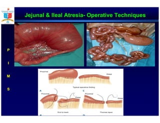 Jejunal & Ileal Atresia- Operative Techniques
P
I
M
S
 