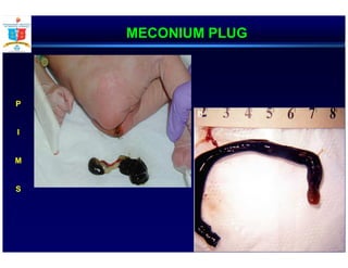 MECONIUM PLUG
P
I
M
S
 