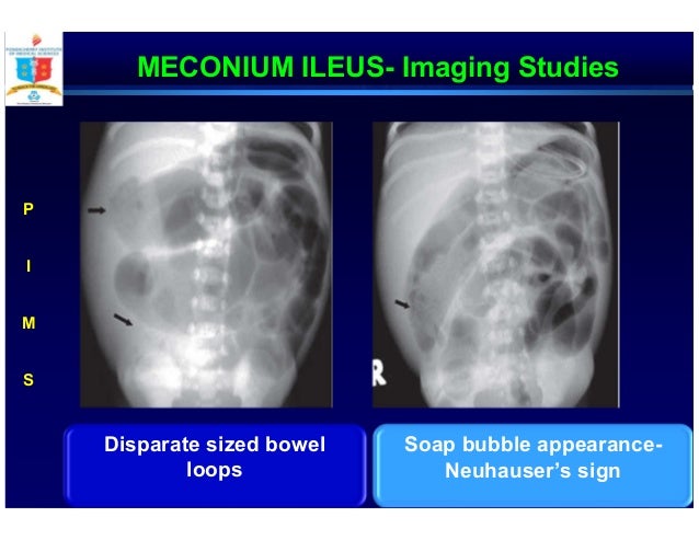 Neonatal Biliary Emesis A Problem Based Approach Neonatal Biliary Emesis A Problem Based Approach