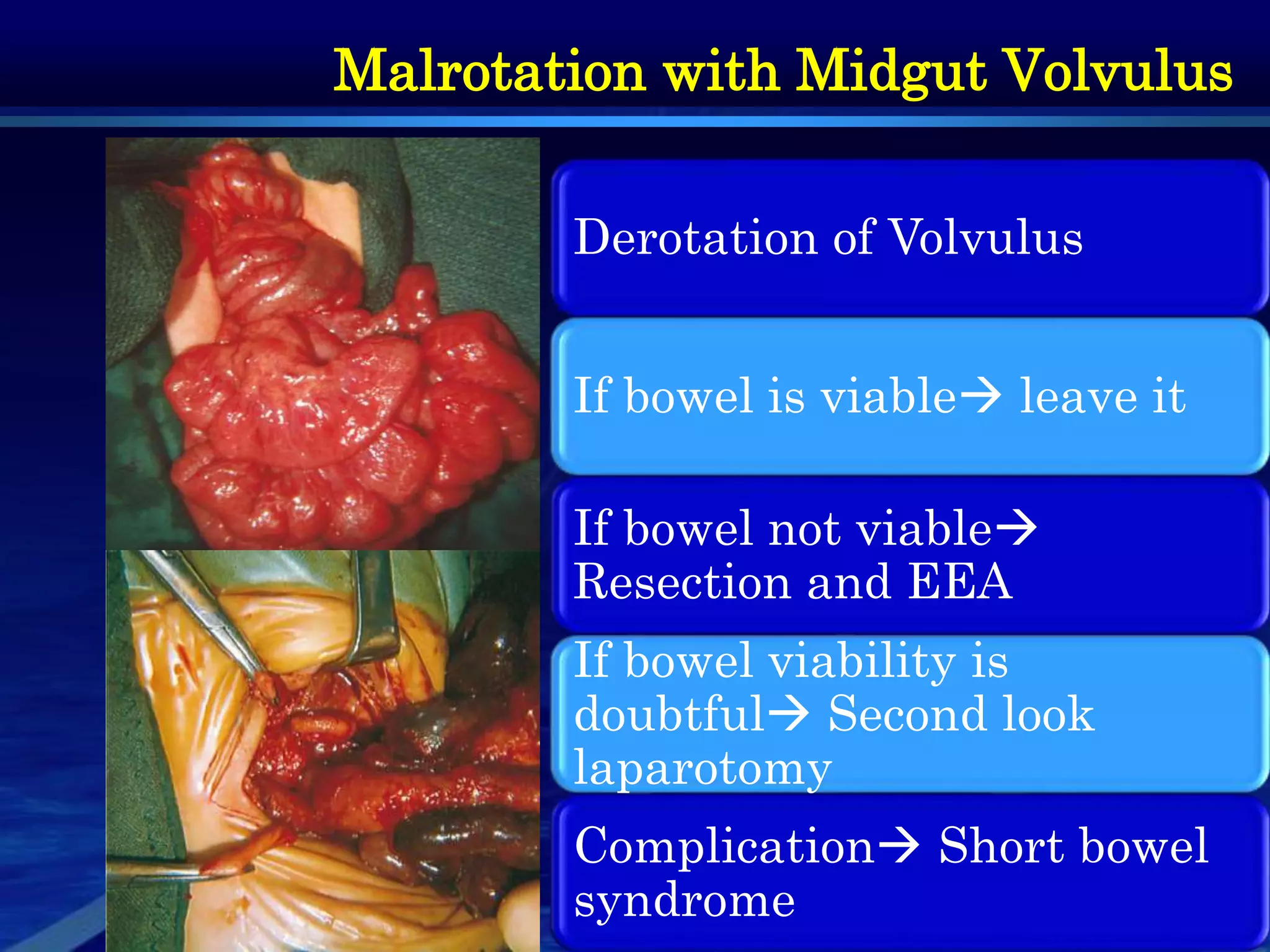 Neonatal Bilious Vomiting- part1 | PPTX
