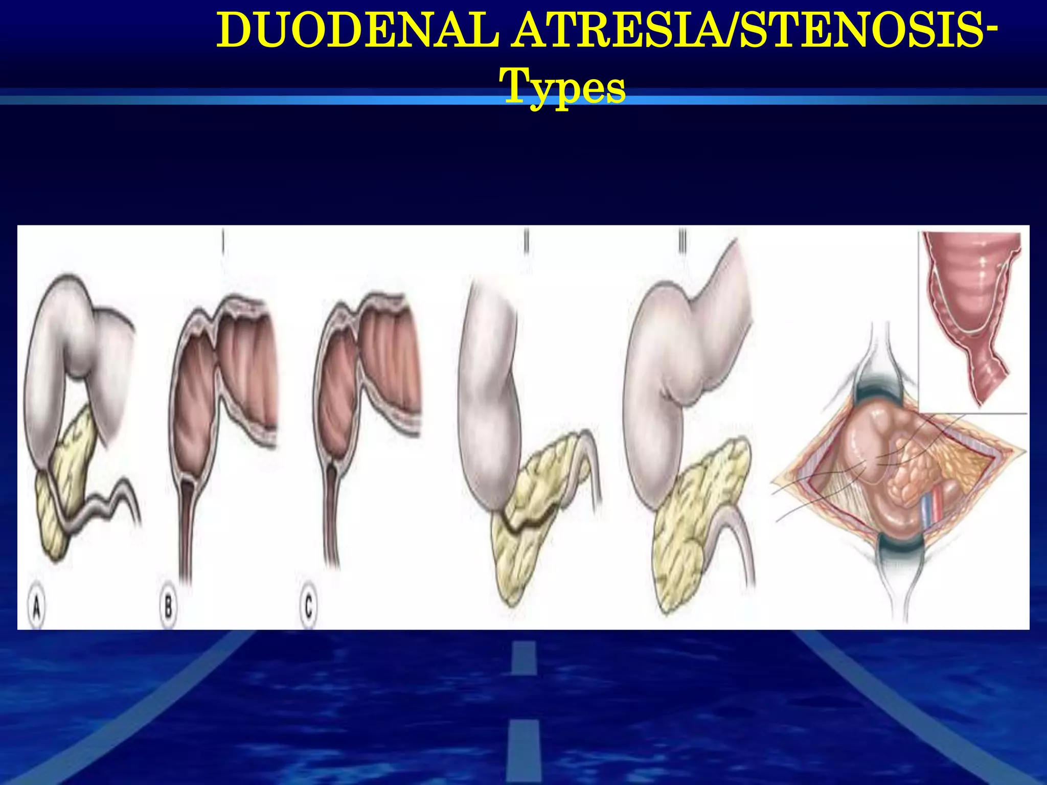 Neonatal Bilious Vomiting- part1 | PPTX