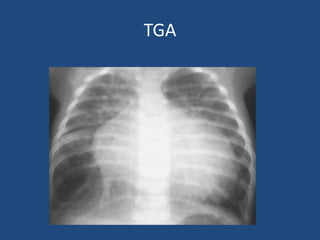 Tga Rch Neonatal cardiac emergency | PPTX