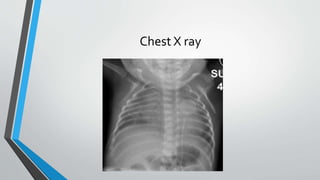Chest X ray 
 
