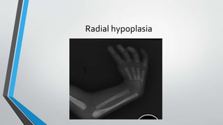 Radial hypoplasia 
 