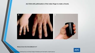 (A) Child with pollicisation of the index finger to make a thumb. 
Watson S Arch Dis Child 2000;83:10-17 
Copyright © BMJ Publishing Group Ltd & Royal College of Paediatrics and Child Health. All rights reserved. 
 