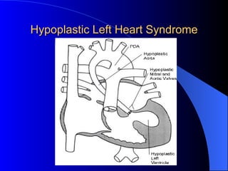 Hypoplastic Left Heart Syndrome 