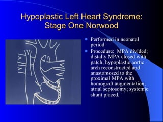Hypoplastic Left Heart Syndrome: Stage One Norwood Performed in neonatal period Procedure:  MPA divided; distally MPA closed with patch; hypoplastic aortic arch reconstructed and anastomosed to the proximal MPA with homograft augmentation; atrial septosomy; systemic shunt placed. 