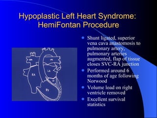 Hypoplastic Left Heart Syndrome:  HemiFontan Procedure Shunt ligated, superior vena cava anastomosis to pulmonary artery, pulmonary arteries augmented, flap of tissue closes SVC-RA junction  Performed around 6 months of age following Norwood Volume load on right ventricle removed Excellent survival statistics  