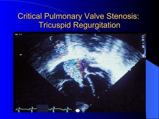 Critical Pulmonary Valve Stenosis:  Tricuspid Regurgitation 