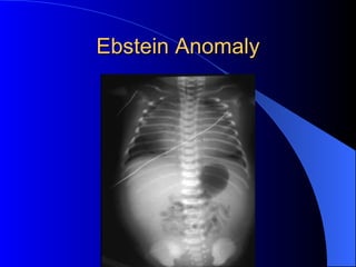 Ebstein Anomaly 