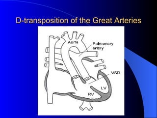 D-transposition of the Great Arteries 