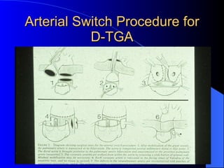 Arterial Switch Procedure for D-TGA 