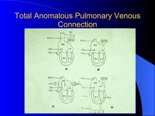 Total Anomalous Pulmonary Venous Connection 