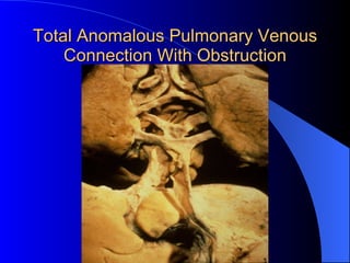 Total Anomalous Pulmonary Venous Connection With Obstruction 